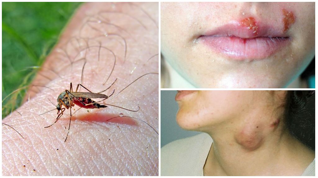 комары и болезни