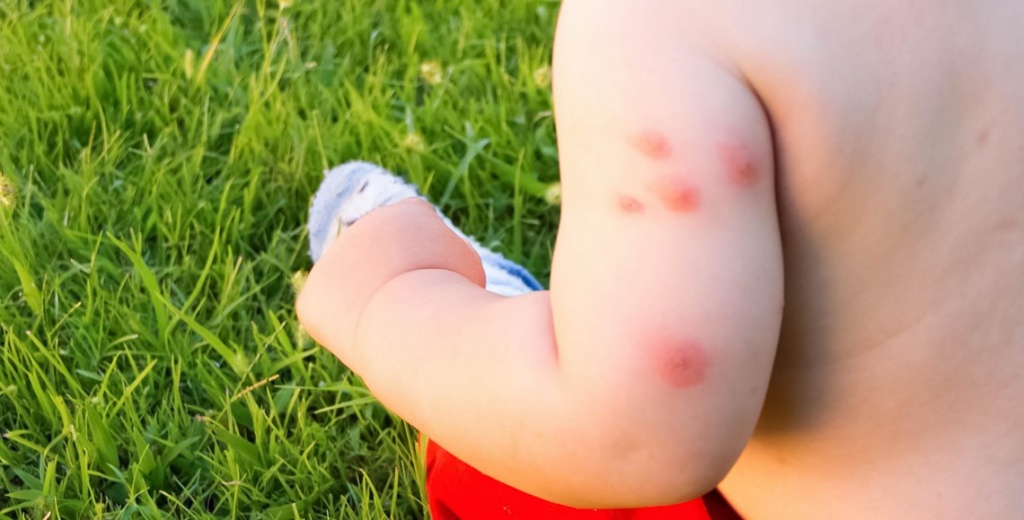 укус комара у ребенка