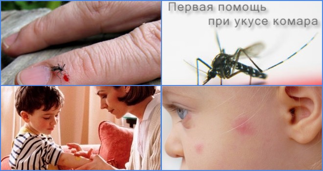 Помощь ребенку при укусе комара