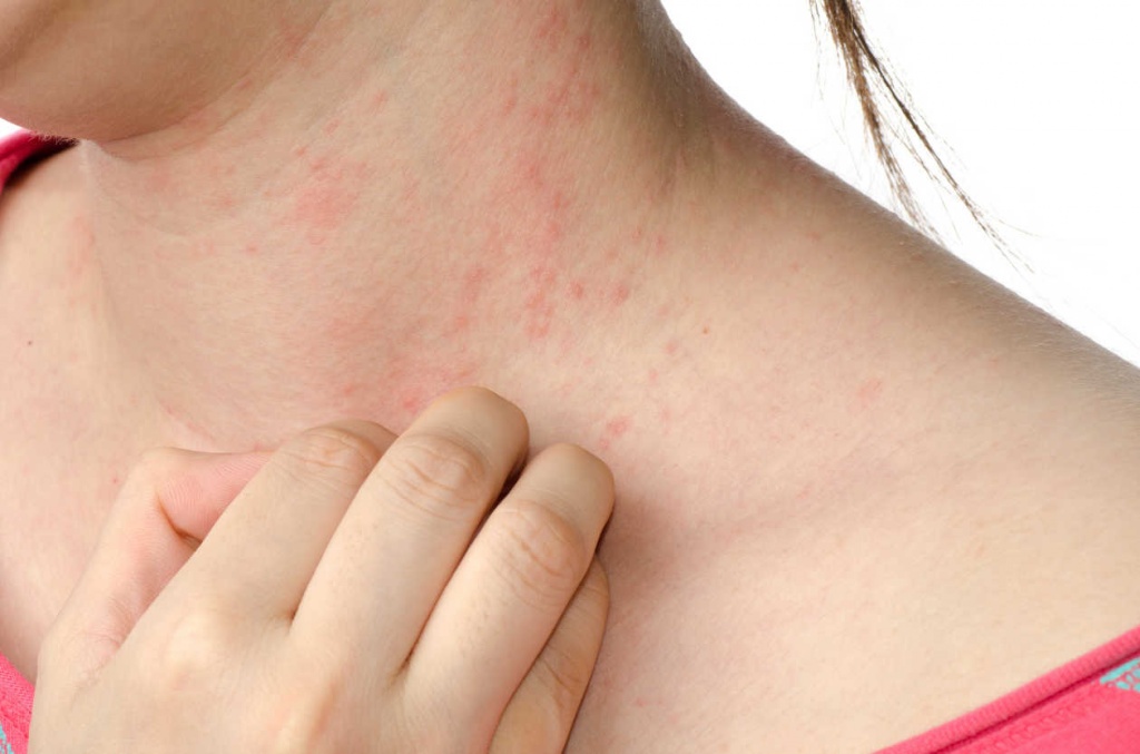 как отличить аллергию от укусов